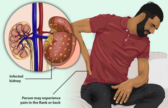 kidney infection Health Line.com November 21, 2024